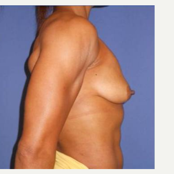 Subglandular Breast Augmentation before 3650822