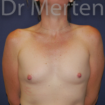 35-44 year old woman treated with Breast Augmentation before 3551957