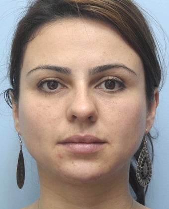 Facial Dermafillers 981010