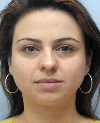 Facial Dermafillers 981010
