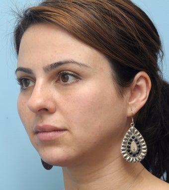 Facial Dermafillers after 981010