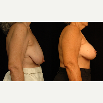 65-74 year old woman treated with Breast Lift with Implants after 3659800