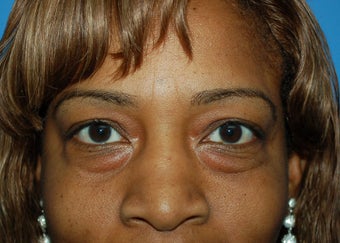 fat repostion lower lids before 1124457