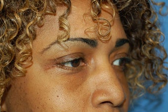 fat repostion lower lids 1124457