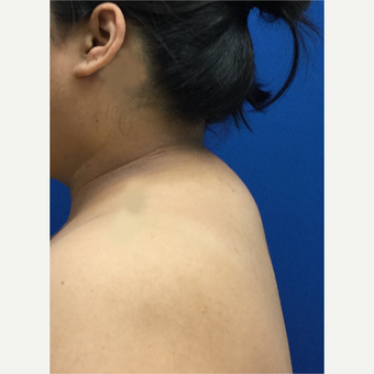 Laser Liposuction of 'Buffalo Hump' before 3259376