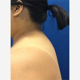 Laser Liposuction of 'Buffalo Hump' after 3259376
