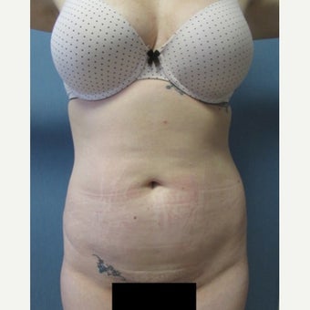 29 year old patient - Liposuction of Abdomen & Bilateral Flanks before 2259090