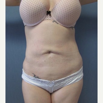 29 year old patient - Liposuction of Abdomen & Bilateral Flanks after 2259090