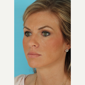 25-34 year old woman treated with Rhinoplasty before 3690993