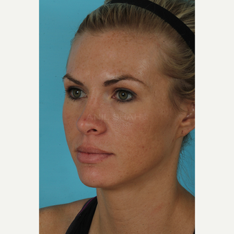 25-34 year old woman treated with Rhinoplasty after 3690993