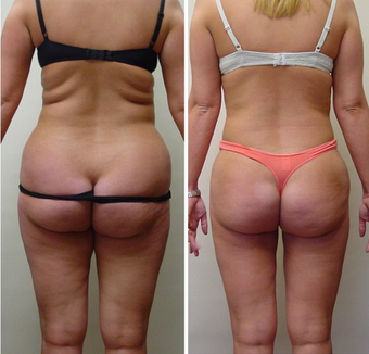 28 yr old woman requesting liposuction for resistant fat areas after 680158