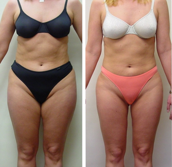 28 yr old woman requesting liposuction for resistant fat areas before 680158