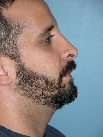 Male Rhinoplasty after 1320659