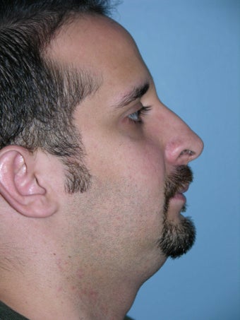 Male Rhinoplasty before 1320659