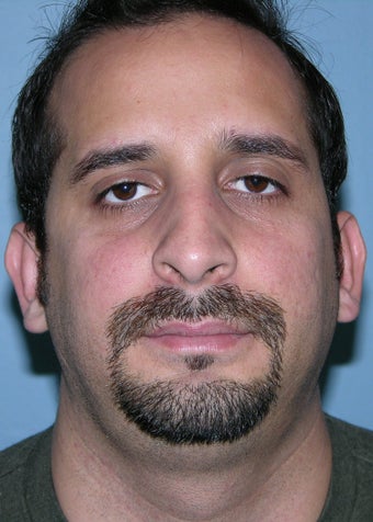 Male Rhinoplasty 1320659