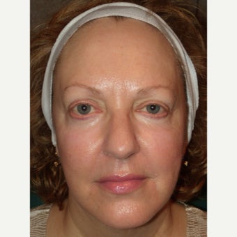 45-54 year old woman treated with RadiantLift Procedure after 1933067