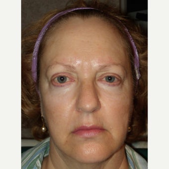 45-54 year old woman treated with RadiantLift Procedure before 1933067