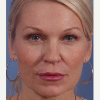 45-54 year old woman treated with Bellafill/ArteFill before 3725350