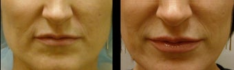 Juvederm for Lip Augmentation before 981987