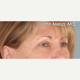 45-54 year old woman treated with Eye Bags Treatment before 3659917