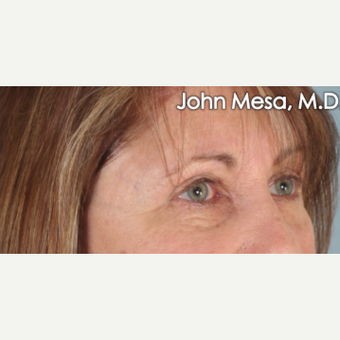 45-54 year old woman treated with Eye Bags Treatment after 3659917