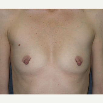 35-44 year old woman treated with Breast Implants before 3455373