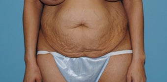 25-34 year old woman treated with Tummy Tuck before 3056130