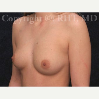 20 year old woman treated with silicone implants before 2413484