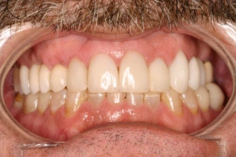 53 Year Old Male gets Smile Makeover after 844770