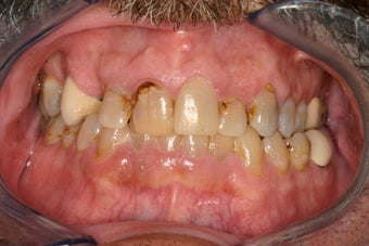 53 Year Old Male gets Smile Makeover before 844770
