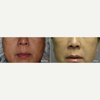55-64 year old woman treated with IPL before 3241632