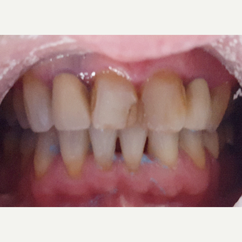 55-64 year old man treated with Porcelain Crowns before 3197205