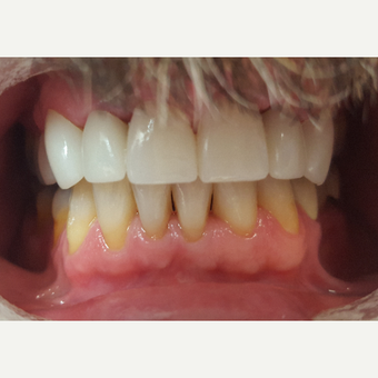 55-64 year old man treated with Porcelain Crowns after 3197205