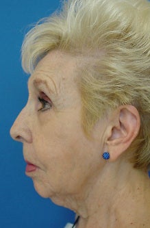 Face Lift before 1211218