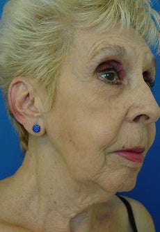 Face Lift 1211218