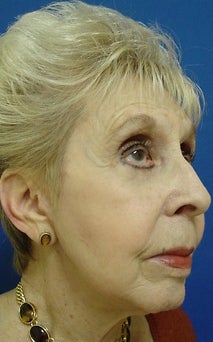 Face Lift 1211218