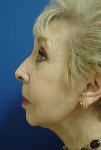 Face Lift after 1211218