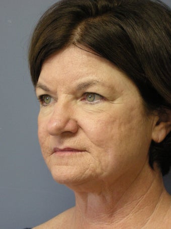 LiteLift™, Blepharoplasty, Temple Brow Lift on 62-year-old Woman 1074453