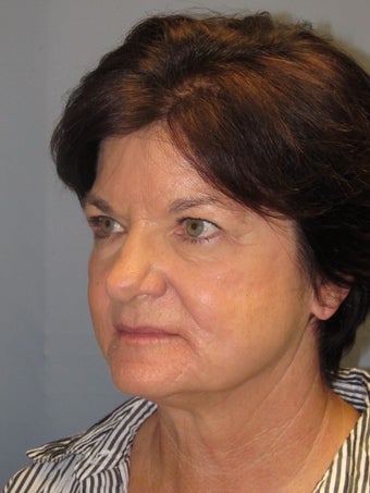 LiteLift™, Blepharoplasty, Temple Brow Lift on 62-year-old Woman 1074453
