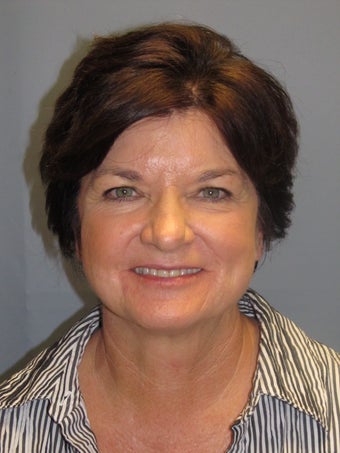 LiteLift™, Blepharoplasty, Temple Brow Lift on 62-year-old Woman after 1074453