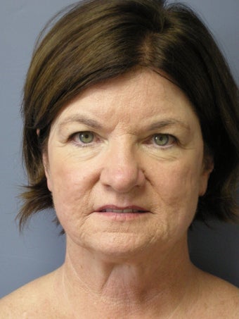 LiteLift™, Blepharoplasty, Temple Brow Lift on 62-year-old Woman before 1074453