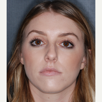 18-24 year old woman treated with Nose Surgery 1 year post-op before 3499836