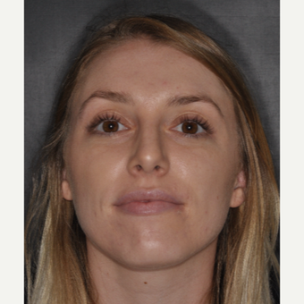 18-24 year old woman treated with Nose Surgery 1 year post-op after 3499836