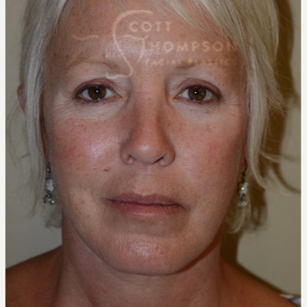 55-64 year old woman treated with Facelift after 3399077