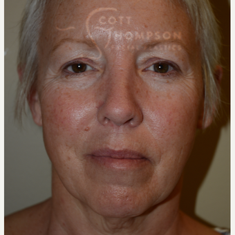 55-64 year old woman treated with Facelift before 3399077