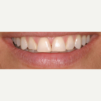 18-24 year old female treated with Lumineers before 3428154