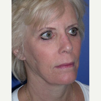Neck Lift 1686738