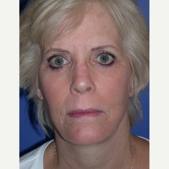 Neck Lift after 1686738