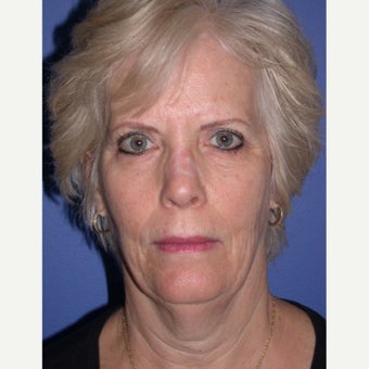 Neck Lift before 1686738
