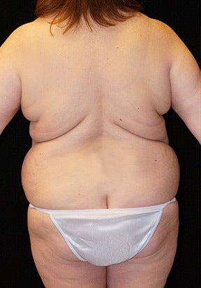 Body Lift 928386